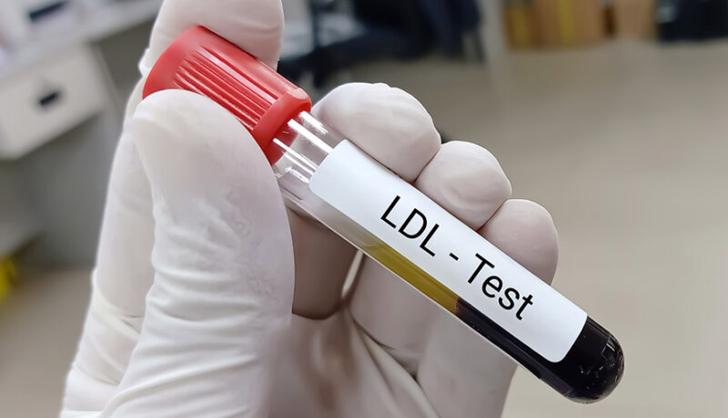LDL Test, ©user19579769- freepik.com
